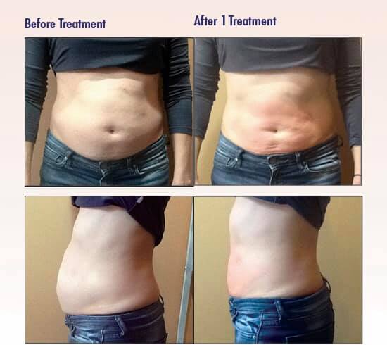 CRYO Body Contouring Treatments in Edmonds - CryoSculpt