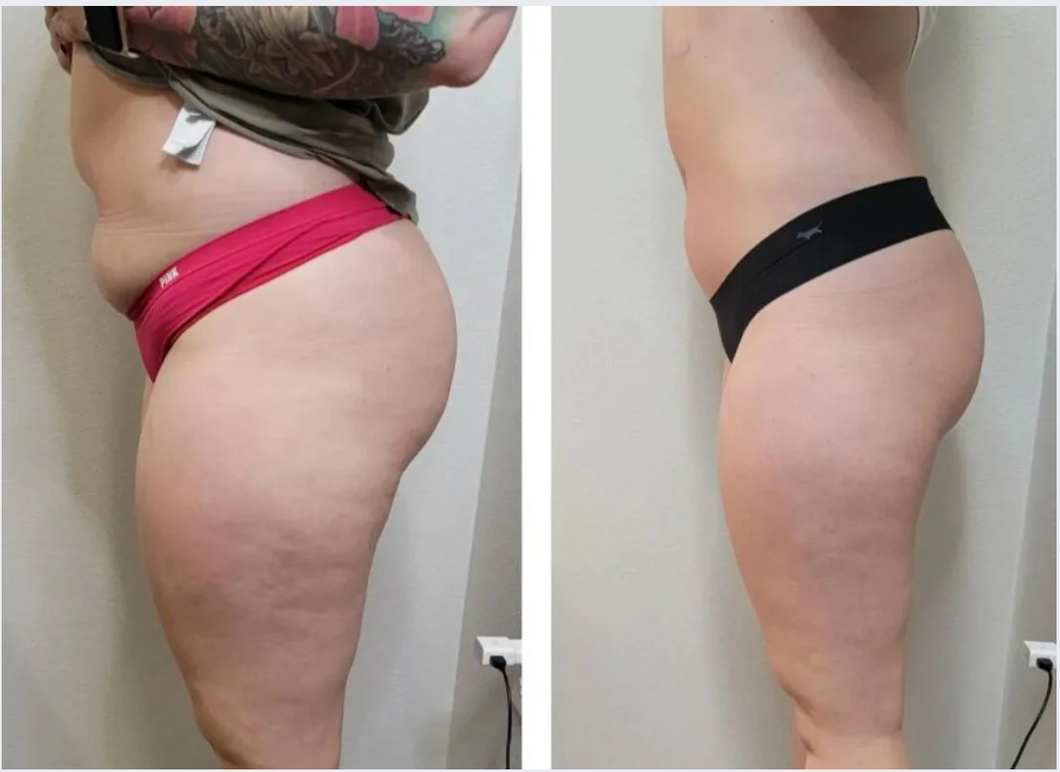 🌞 Summer Contour Pass – 3 Months of Targeted Body Sculpting