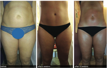 Load image into Gallery viewer, 🌞 Summer Contour Pass – 3 Months of Targeted Body Sculpting
