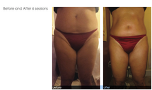 Load image into Gallery viewer, Smooth and Shape: Endospheres Therapy Intro Treatment
