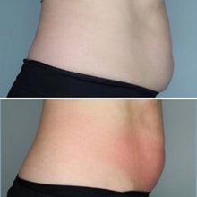 Load image into Gallery viewer, Permanent, Non-Invasive Fat Freezing Treatment
