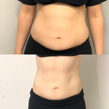 Load image into Gallery viewer, Permanent, Non-Invasive Fat Freezing Treatment
